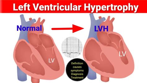 asymmetric lv hypertrophy|left ventricular hypertrophy survival rate.